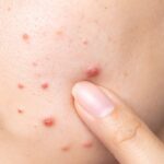 Estresse Causa Espinhas Entenda a Relação entre Emoções e Pele