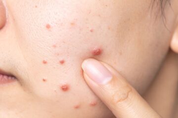 Estresse Causa Espinhas Entenda a Relação entre Emoções e Pele