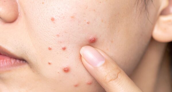 Estresse Causa Espinhas Entenda a Relação entre Emoções e Pele